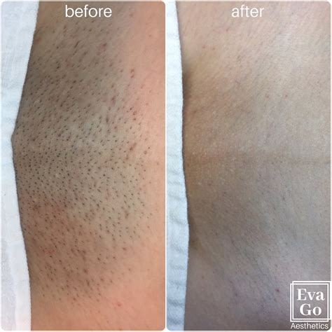 list 94 pictures bikini laser hair removal before and after photos updated