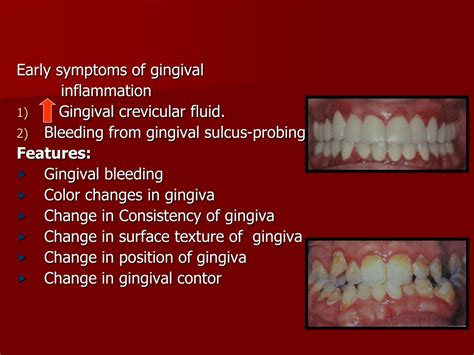 Ppt Gingival And Periodontal Disease Powerpoint Presentation Free
