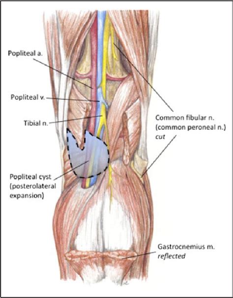 Figure From An Intact Dissecting Bakers Cyst Mimicking Recurrent Deep Vein Thrombosis