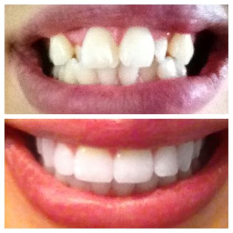 Making Each Minute Count I Got My Braces Off Before And After Pictures
