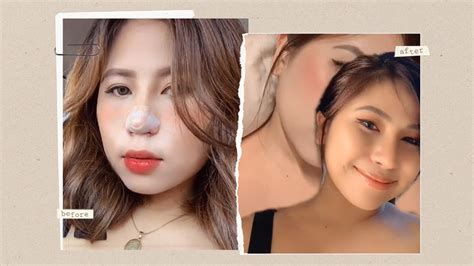 Filipino Nose Job Before And After
