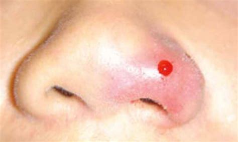 Nose Bleeding Aprof Luke Tan Clinic