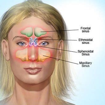 Infections of the dangerous areas of the face. What is sinus plaque? What causes it? - Quora