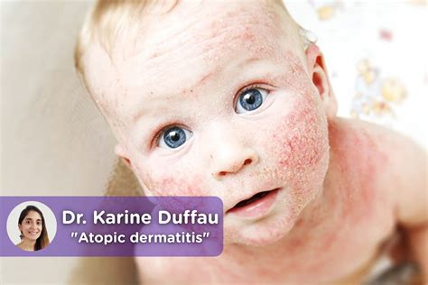 Child Atopic Dermatitis The Treatment To Follow Mediquo