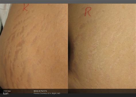 Laser Stretch Mark Removal Before And After Troy Mi