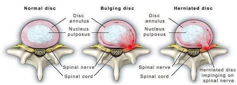 Bulging Disc Vs Herniated Disc