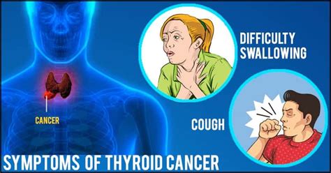 Thyroid Cancer Diagnosis And Treatment From Cancer Specialist In Delhi