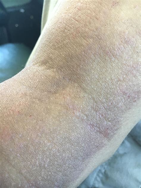 Is There Anyway To Clear Up This Eczema On My Arm My Typical Skincare