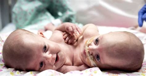 Conjoined Twins Are Successfully Separated