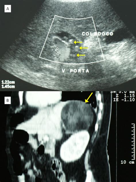 A Ultrasound Aspect Of Dilated Common Bile Duct With Images