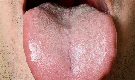 Spots On Tongue Reasons Behind The White Spots On Your Tongue Mahilalu