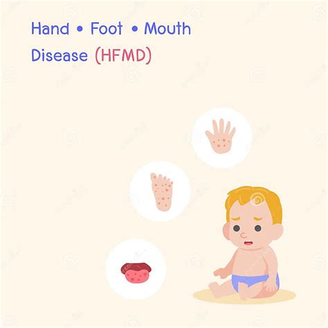 Hand Foot And Mouth Disease Hfmd Medical Health Care Concept Stock