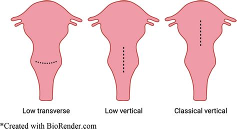 Types Of Cesarean Section Surgical Incisions Diagram Depicts Several Download Scientific
