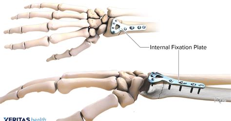 Surgical Options For Treating A Distal Radius Fracture Fractures