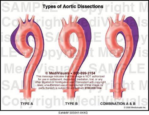 Types Of Aortic Dissections Medical Illustration Medivisuals