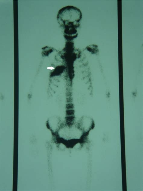 Hemangioma Of The Rib A Rare Case Report And Literature Review