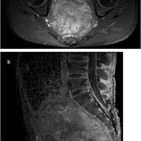 Axial T1 A And Sagittal T1 Fat Sat B Weighted Imaging With