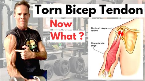 Torn Or Ruptured Bicep Tendon What You Need To Know Youtube