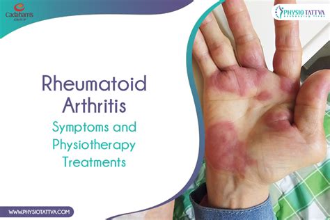 Rheumatoid Arthritis Symptoms Diagnosis And Treatment