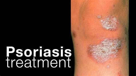 Psoriasis Treatment Options Related Issues Youtube