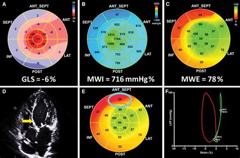 Myocardial Work In Echocardiography Circulation Cardiovascular Imaging