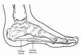 Joint deformities can create a bump on the foot. Plantar Fibroma - Foot Health Facts