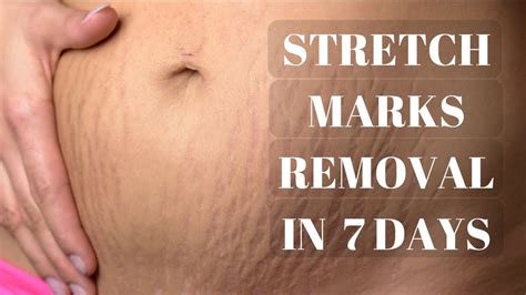 How To Get Rid Of Stretch Marks Naturally Fast Stretch Marks Removed Days At Home YouTube