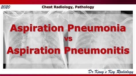Pathophysiology Of Aspiration Pneumonia