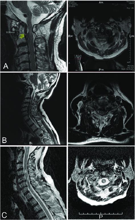 Magnetic Resonance Images Of Cervical Spinal Cords A Sagittal