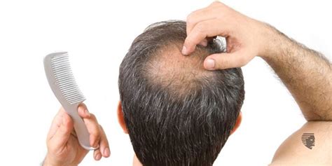 Male Pattern Baldness Symptoms Causes Treatment And Prevention