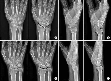 Plain Wrist Radiographs Of The Patient On The Symptomatic Side A B