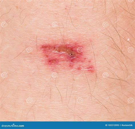 Wound On Skin Stock Image Image Of Healthcare Physical 102212095