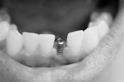 Understanding Bone Grafting For Dental Implants Shields Dental Clinic