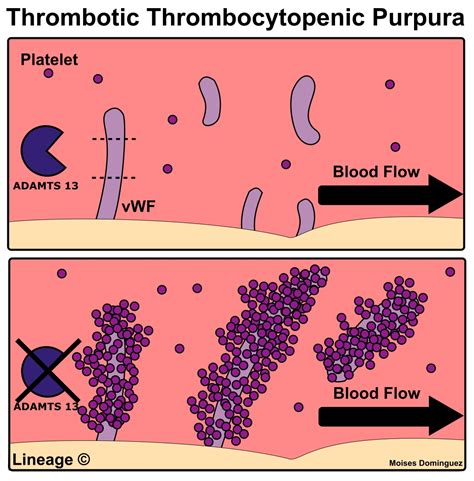 idiopathic thrombocytopenic purpura diagram