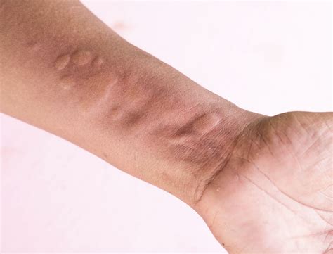 Causes Of Itchy Skin Pruritus Treatments For Rashes Bumps More Dr Michelle Jeffries
