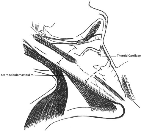Management Of Parapharyngeal And Retropharyngeal Space Infections