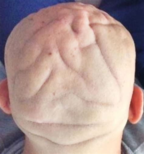 Doctors Release Pictures Of Bizarre Pattern On Mans Head Caused By Too