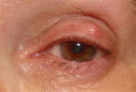 Eyelid Bump Types Pictures Causes And Treatment White Dot Under