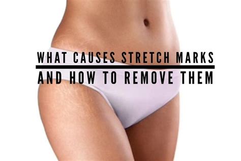 What Causes Stretch Marks And How To Remove Them Fitbod What Causes