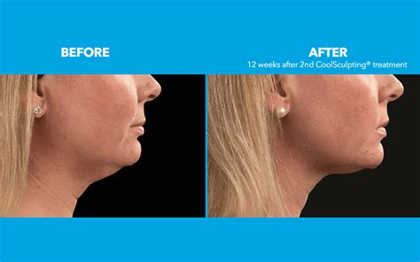 Improving The Appearance Of Lax Tissue Coolsculpting For The Chin