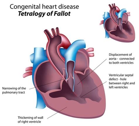 Facts About Tetralogy Of Fallot