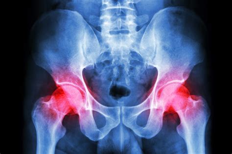 What Is Hip Bursitis Orthoindy Blog
