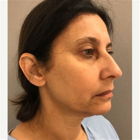 Facelift Before And After Photos By Franklin Richards Md Bethesda Md Case 46133 Asps