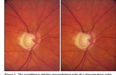 Pdf The Value Of Stereoscopic Optic Disc Photography An Update On