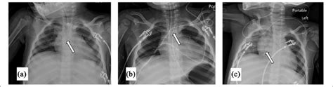 A Initial Placement Cxr With Tip Of Picc At The Svcra