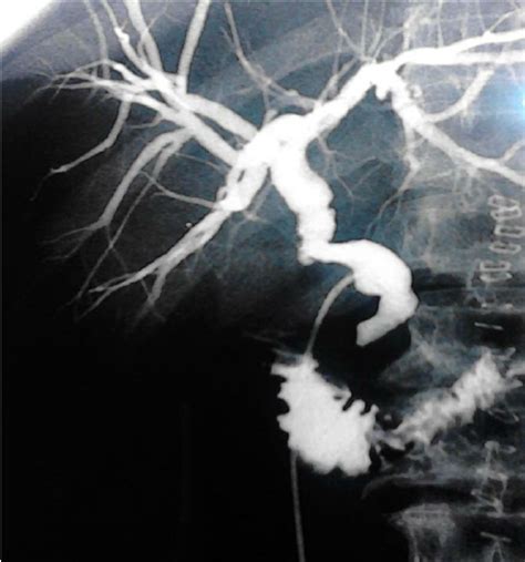 T Tube Cholangiography Performed One Week After Surgery Showed Normal