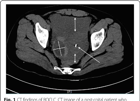 Diagnostic Utility Of Ct In Differentiating Between Ruptured Ovarian