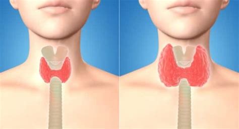 Dont Ignore These Signs Of Thyroid Cancer Read Health Related Blogs