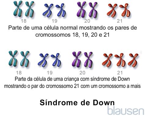 Síndrome De Down Trissomia 21 Problemas De Saúde Infantil Manual