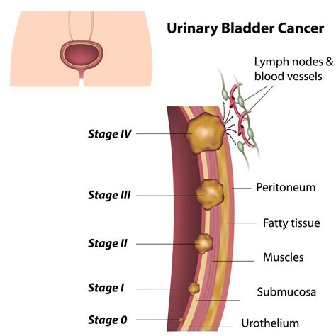 Symptoms include blood in the urine, pain with urination, and low back pain. Bladder Function | anatomy, function, diseases, images